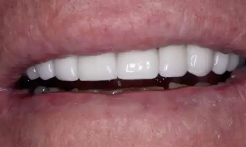 Close-up of a person's mouth showing a set of white teeth.