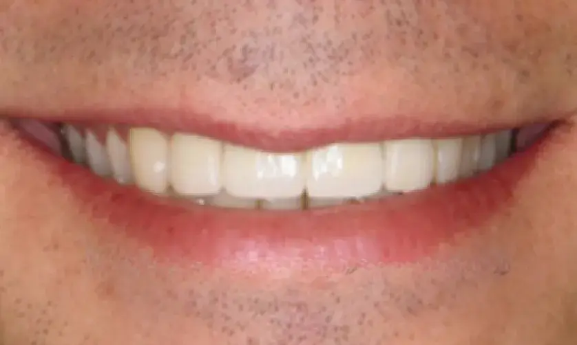A close-up of a smiling mouth showing clean, white teeth and some facial stubble.