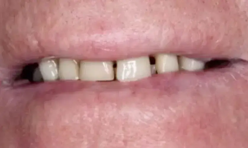 A close-up of a person's closed mouth showing teeth through slightly parted lips.